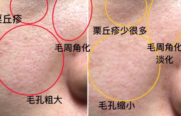 毛囊角化与毛周角化的区别，青岛皮肤病专科医院日常防治方法