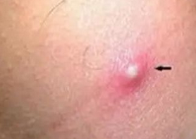 痤疮和毛囊炎发病位置、诱因、症状有哪些？青岛皮肤病医院