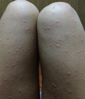 荨麻疹的4种一般护理措施，青岛皮肤病研究所