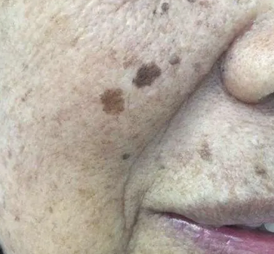 老年人如何预防老年斑？青岛皮肤病医院5种预防方式