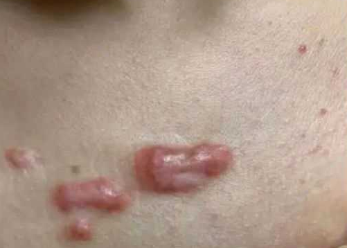 青岛治疗疤痕哪家医院好－如何去除凸起的疤痕？
