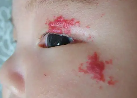 青岛皮肤病医院红色胎记去除一般要多少钱？
