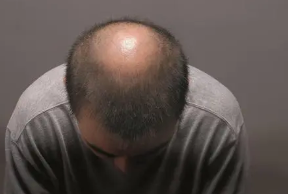 很多脱发的原因是什么？青岛皮肤病医院分享4个脱发原因